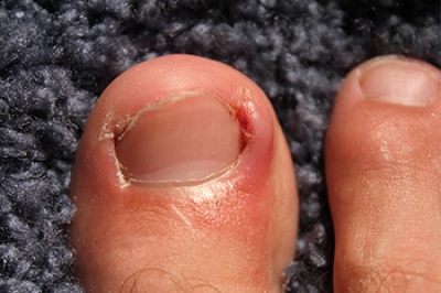 Key Facts About Ingrown Toenails