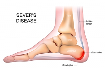 Symptoms and Risk Factors of Sever’s Disease