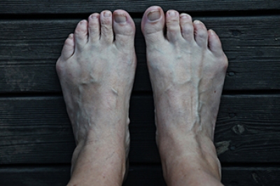 What Is Tailor’s Bunion?